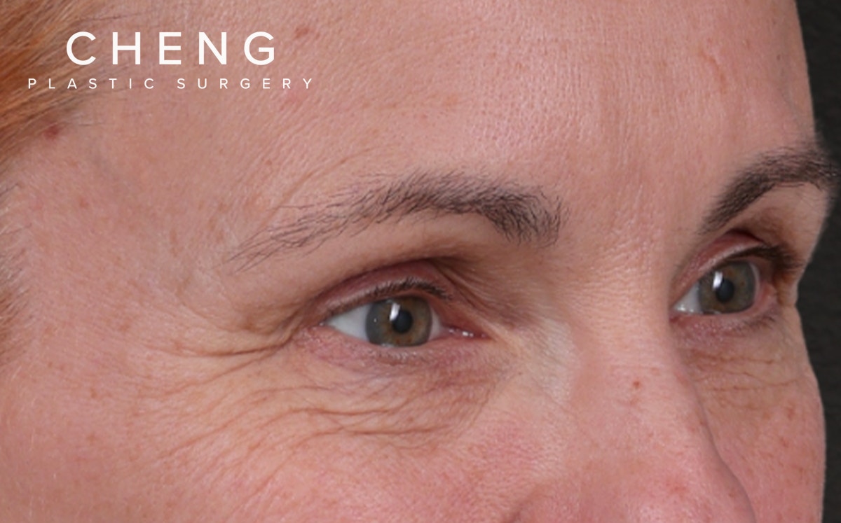 Blepharoplasty Before & After Gallery - Patient 117386 - Image 3