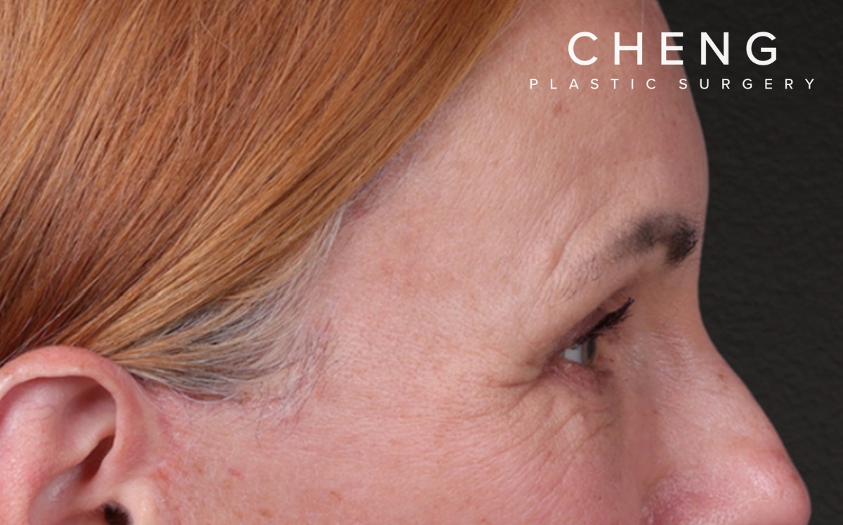 Blepharoplasty Before & After Gallery - Patient 117386 - Image 6