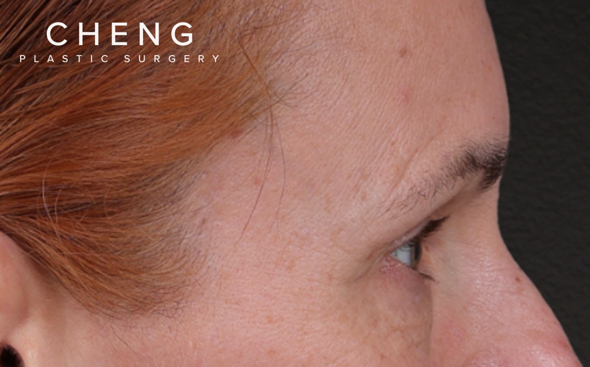 Blepharoplasty Before & After Gallery - Patient 117386 - Image 5
