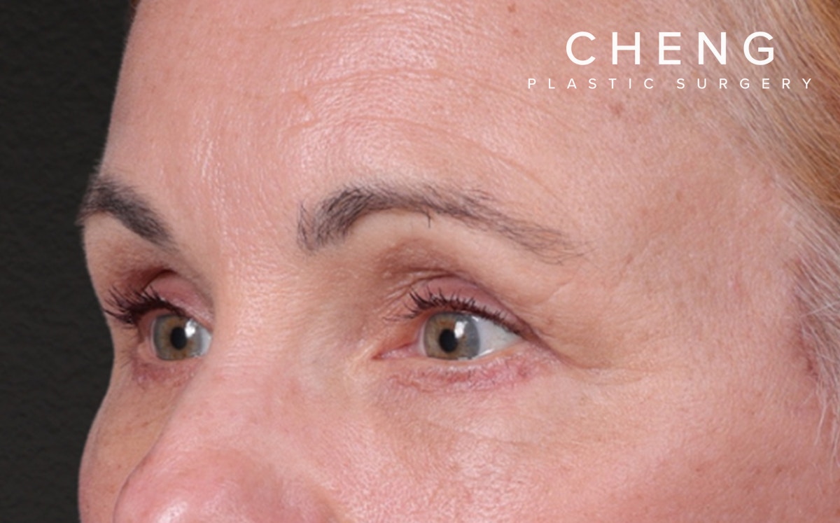 Blepharoplasty Before & After Gallery - Patient 117386 - Image 8
