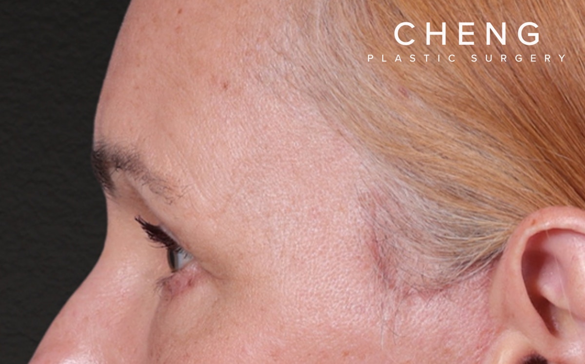 Blepharoplasty Before & After Gallery - Patient 117386 - Image 10