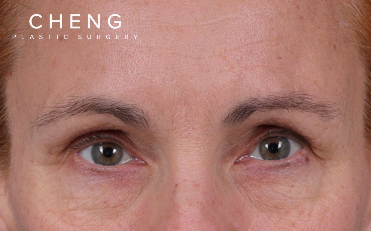 Blepharoplasty Before & After Gallery - Patient 117386 - Image 1