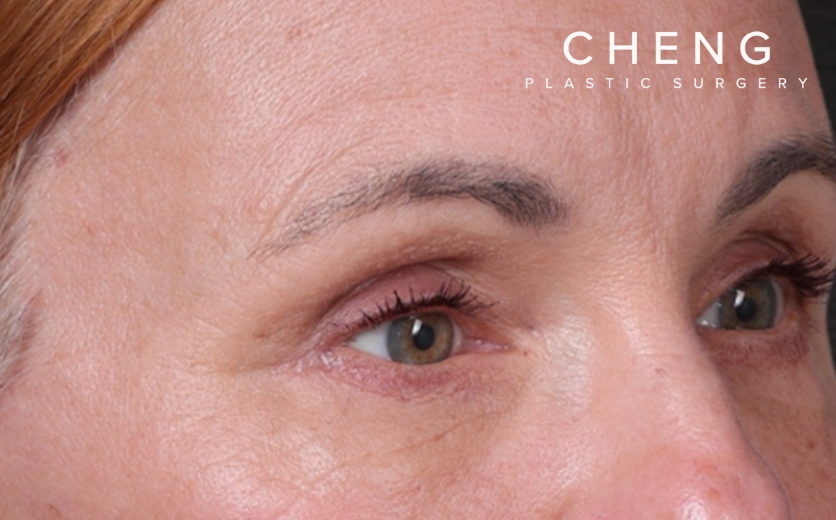 Blepharoplasty Before & After Gallery - Patient 117386 - Image 4