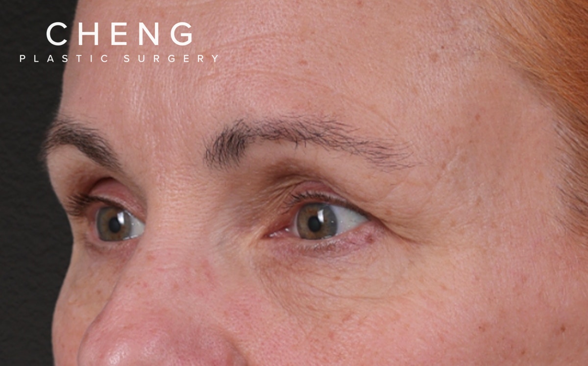 Blepharoplasty Before & After Gallery - Patient 117386 - Image 7