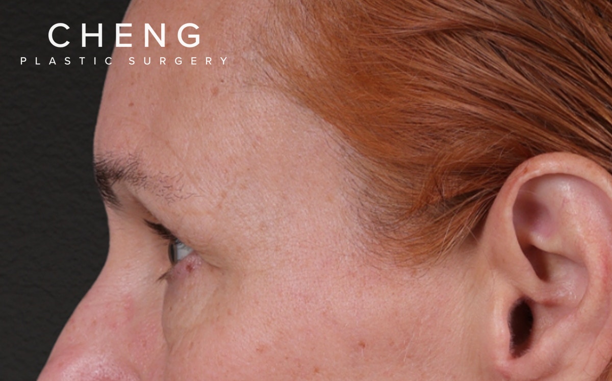 Blepharoplasty Before & After Gallery - Patient 117386 - Image 9