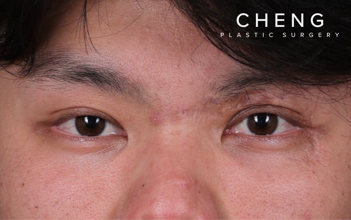 Blepharoplasty Before & After Gallery - Patient 385909 - Image 2