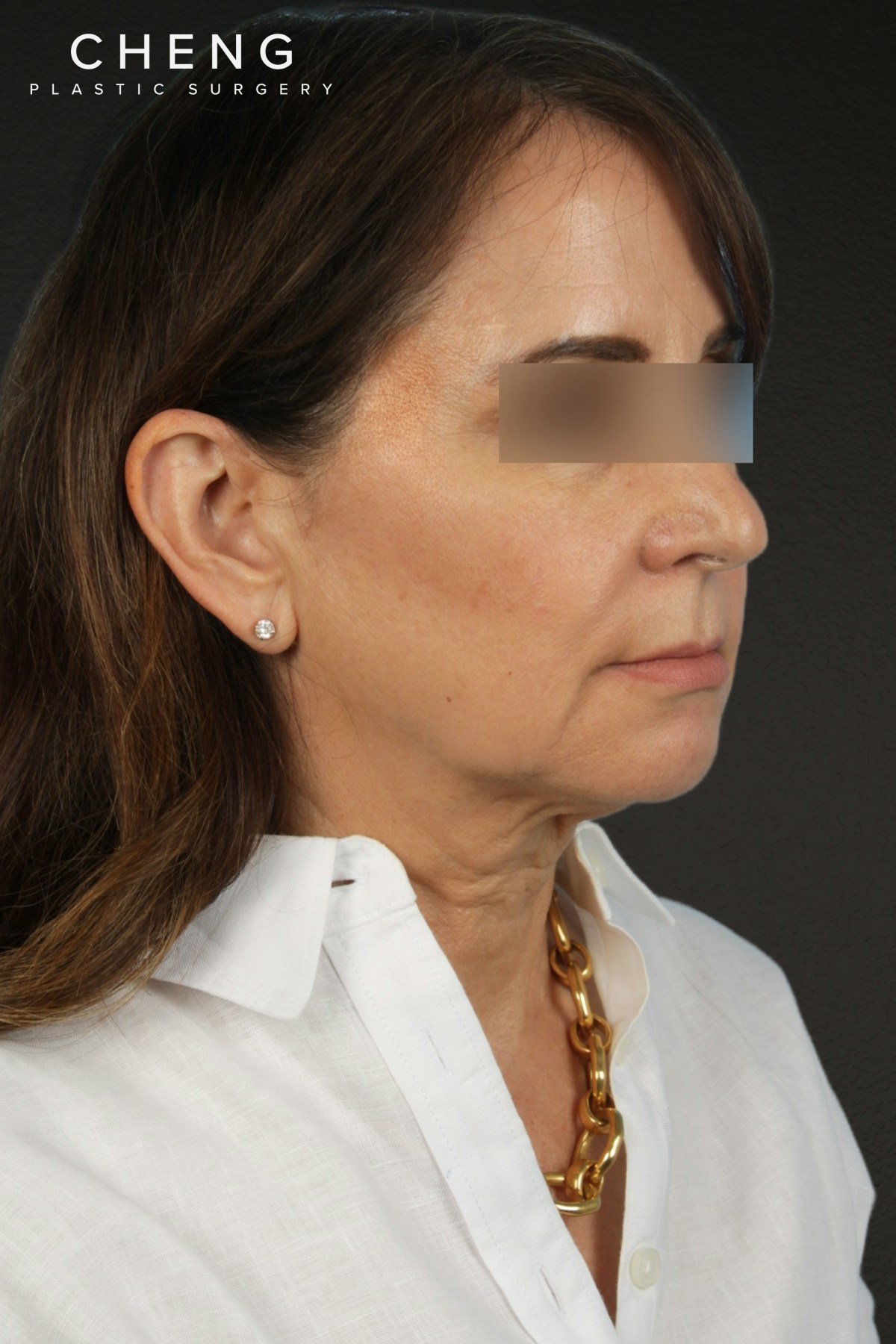 Facelift Before & After Gallery - Patient 407291 - Image 5