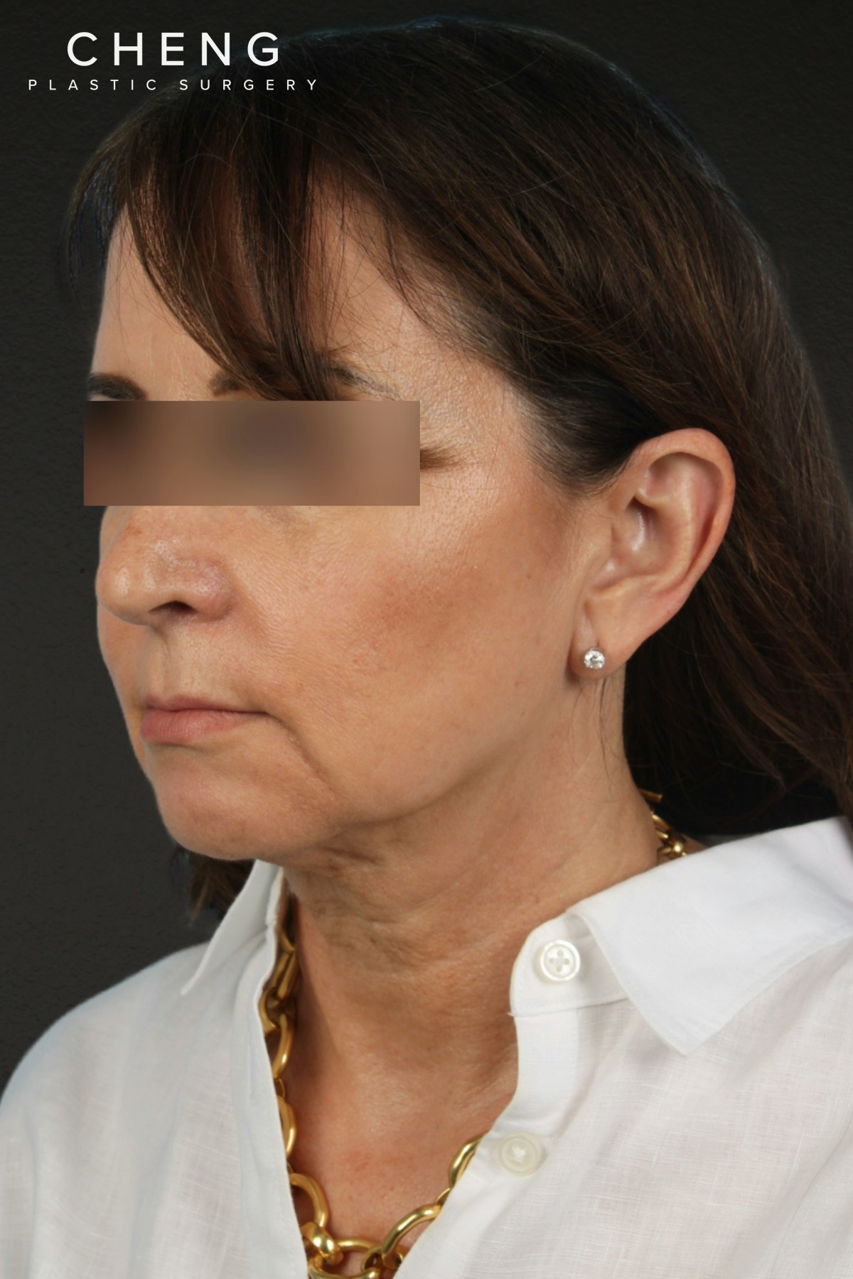 Facelift Before & After Gallery - Patient 407291 - Image 7