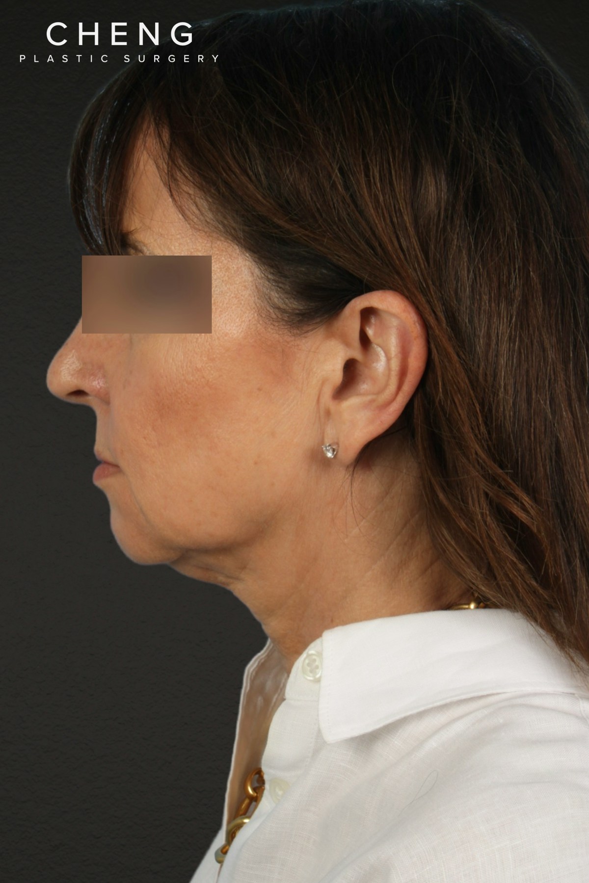 Facelift Before & After Gallery - Patient 407291 - Image 3