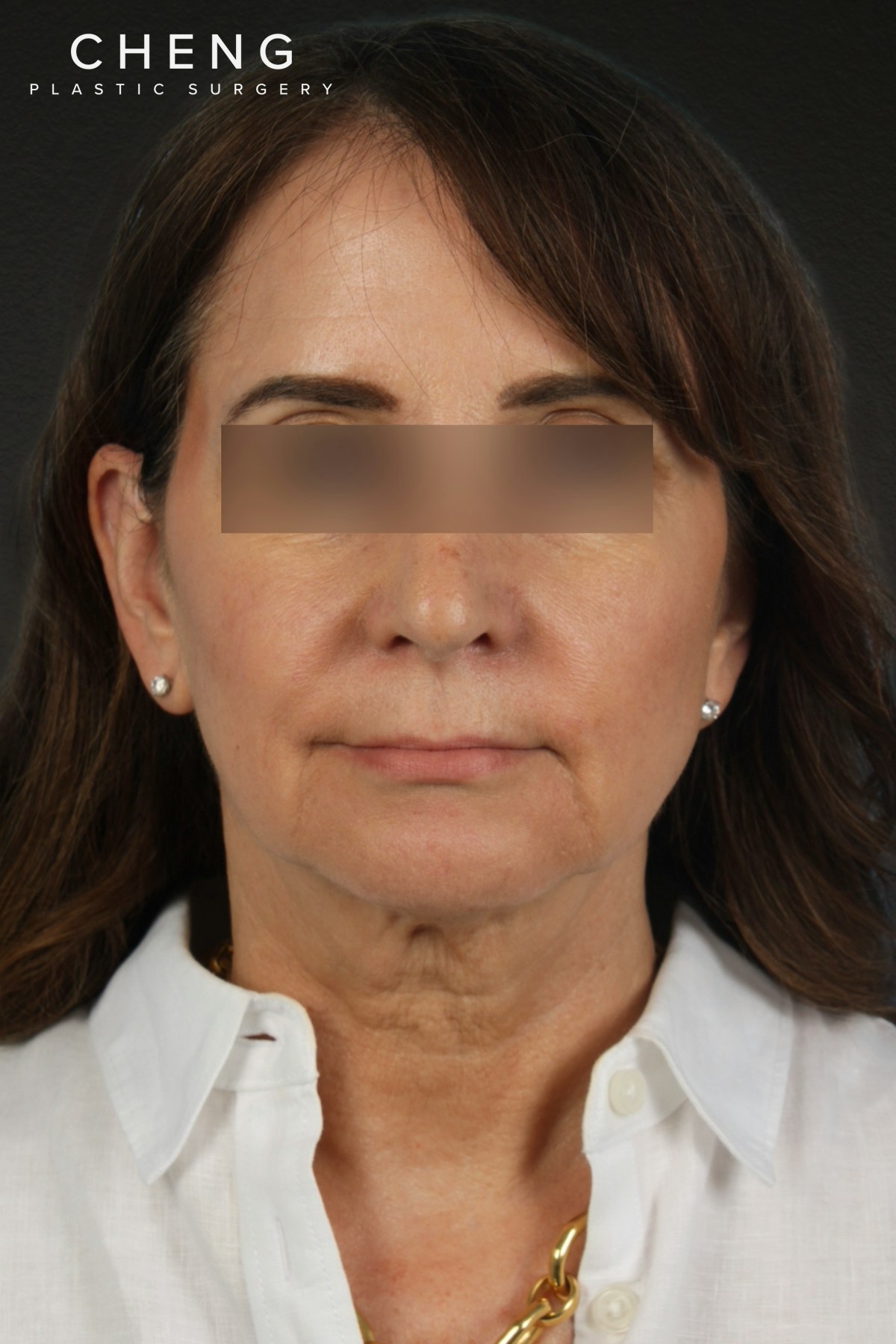Facelift Before & After Gallery - Patient 407291 - Image 1