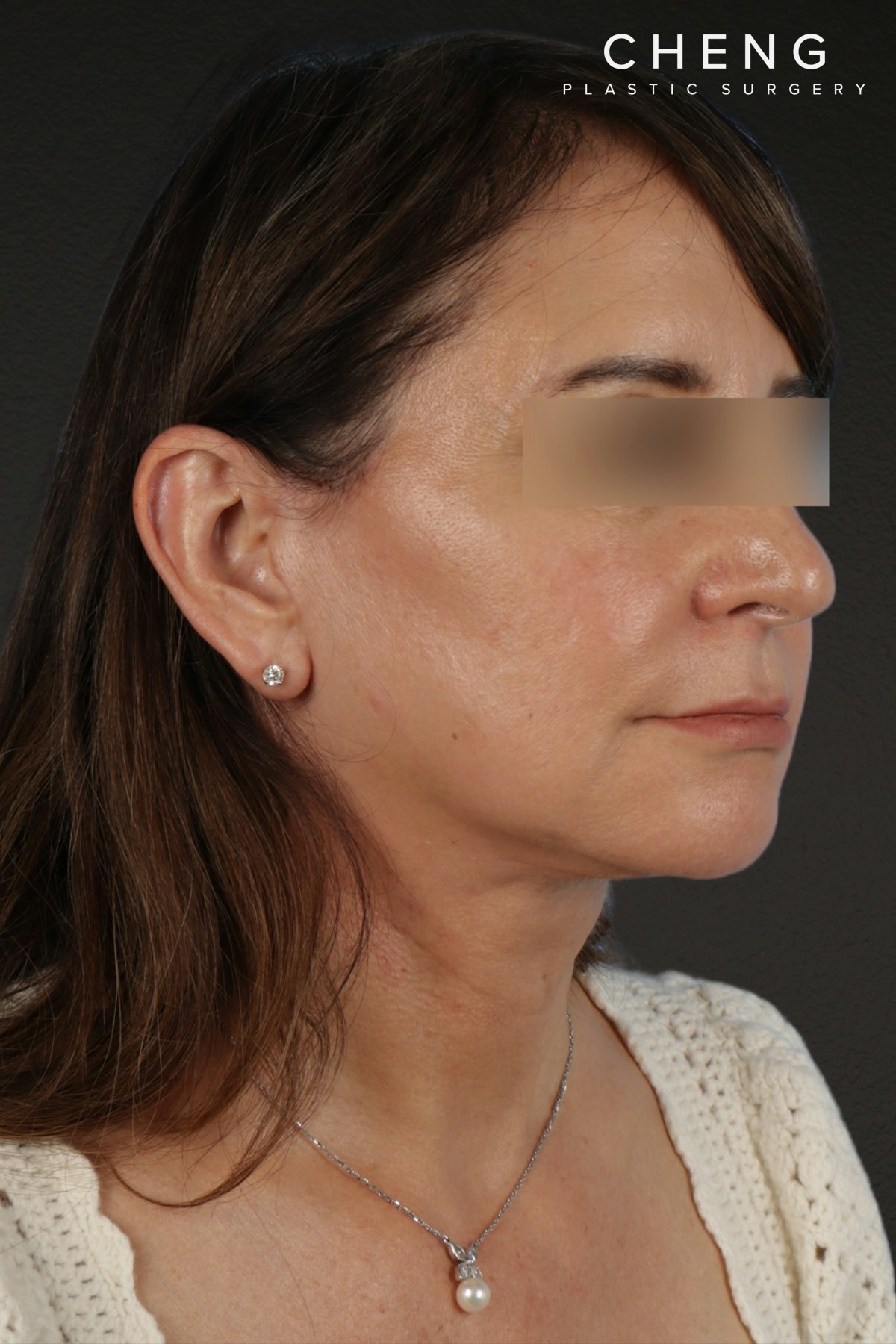 Facelift Before & After Gallery - Patient 407291 - Image 6