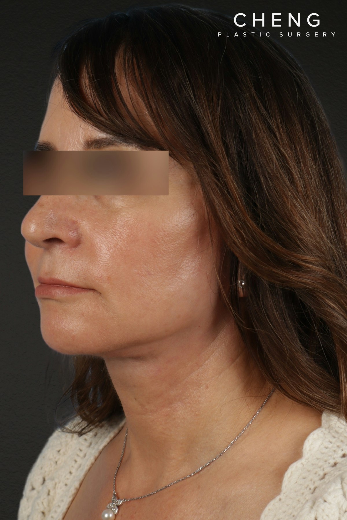 Facelift Before & After Gallery - Patient 407291 - Image 8