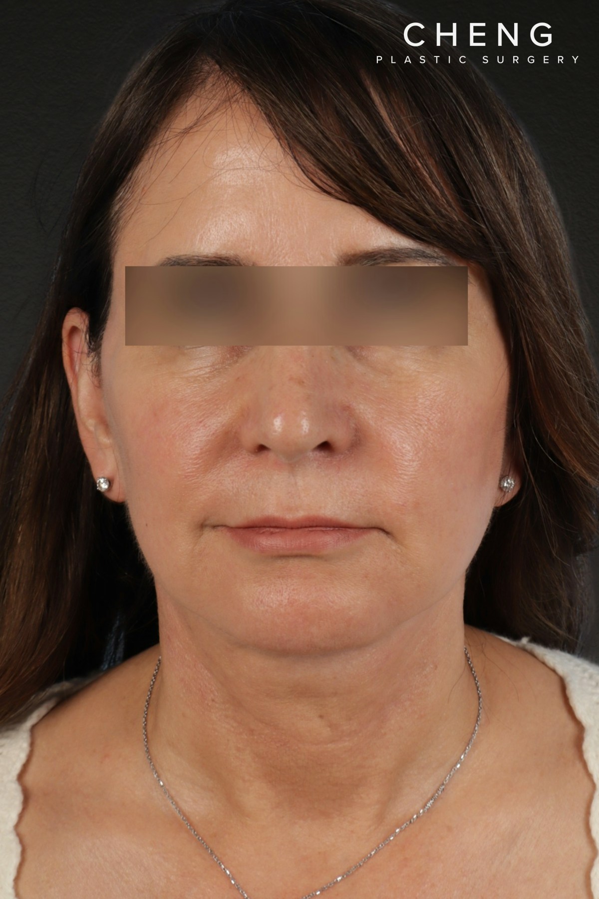 Facelift Before & After Gallery - Patient 407291 - Image 2
