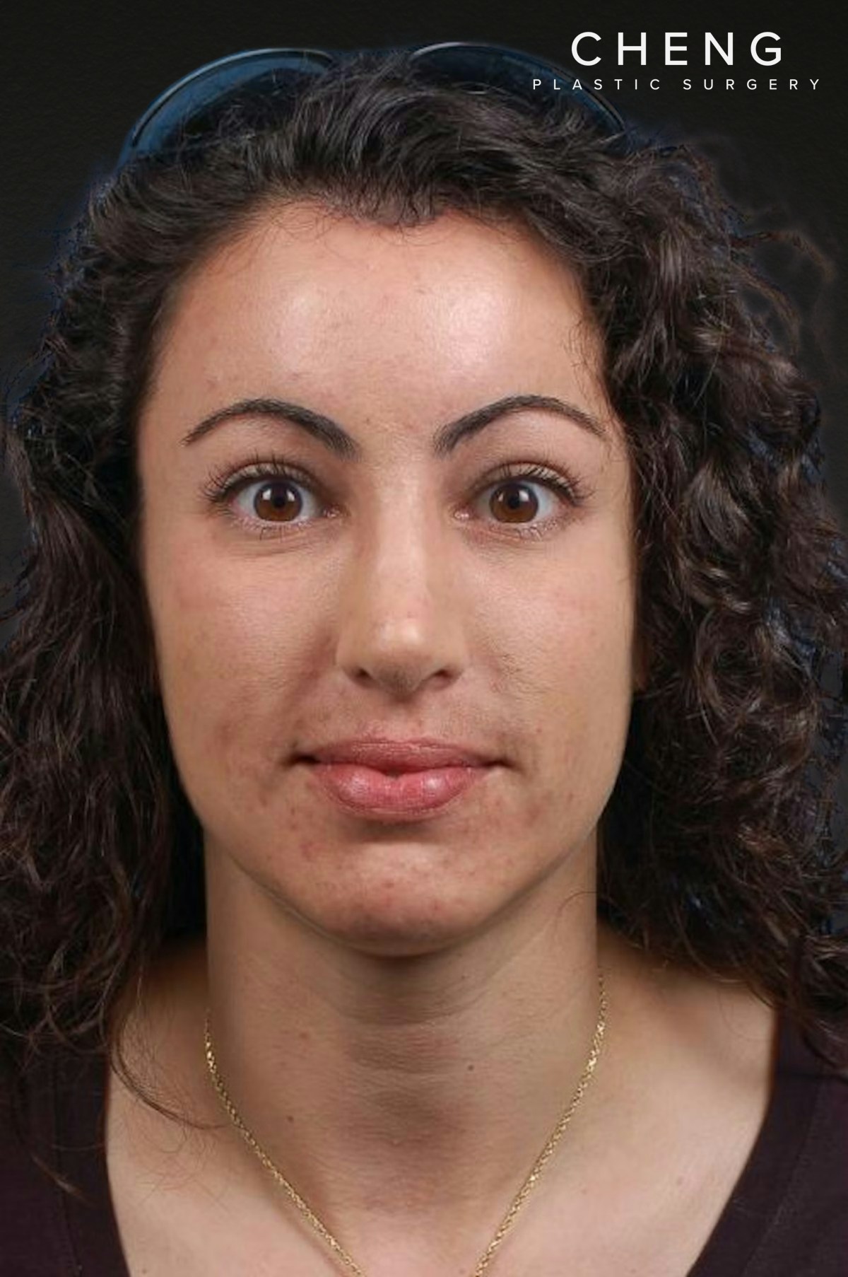 Brow Lift Before & After Gallery - Patient 978632 - Image 2