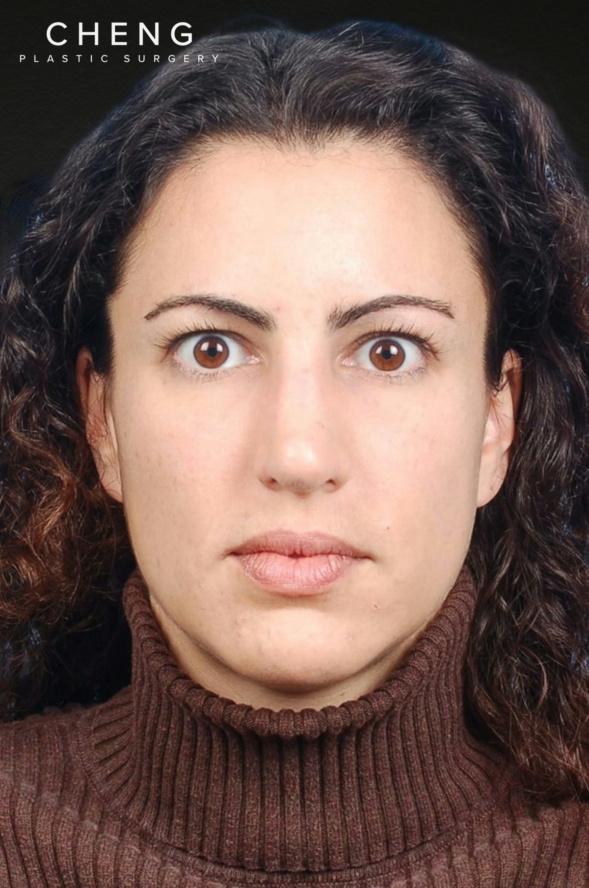 Brow Lift Before & After Gallery - Patient 978632 - Image 1