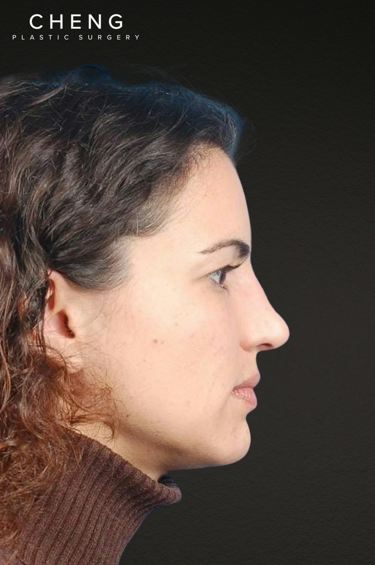 Brow Lift Before & After Gallery - Patient 978632 - Image 3