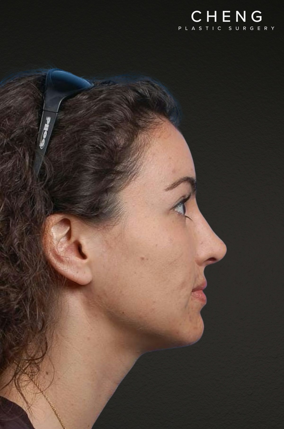 Brow Lift Before & After Gallery - Patient 978632 - Image 4