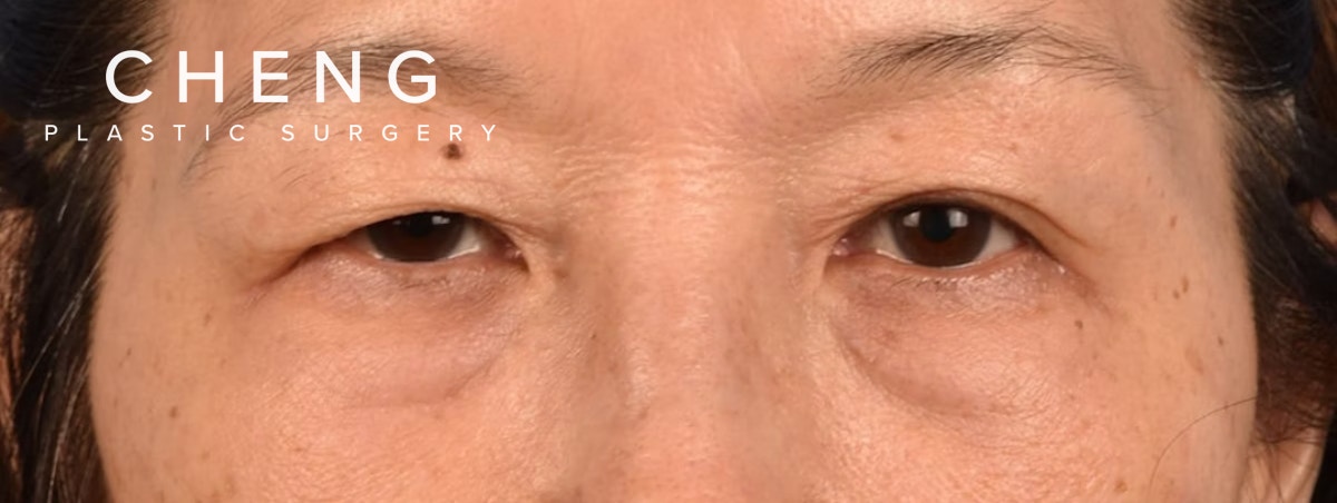 Brow Lift Before & After Gallery - Patient 542005 - Image 1