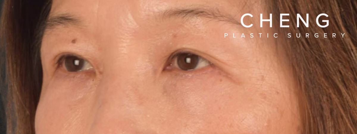 Brow Lift Before & After Gallery - Patient 542005 - Image 6