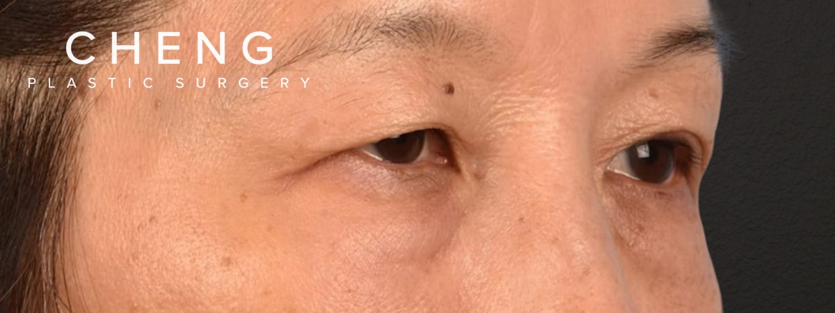 Brow Lift Before & After Gallery - Patient 542005 - Image 3