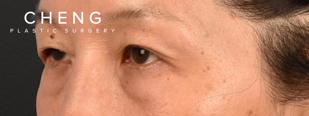 Brow Lift Before & After Gallery - Patient 542005 - Image 5
