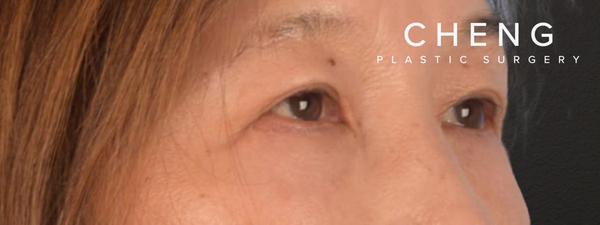 Brow Lift Before & After Gallery - Patient 542005 - Image 4