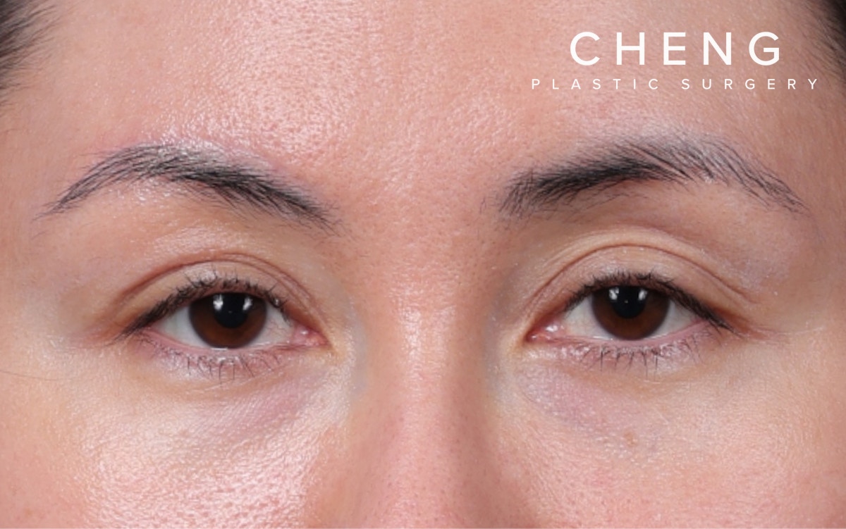 Blepharoplasty Before & After Gallery - Patient 751991 - Image 2