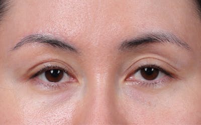Brow Lift Before & After Gallery - Patient 324298 - Image 2