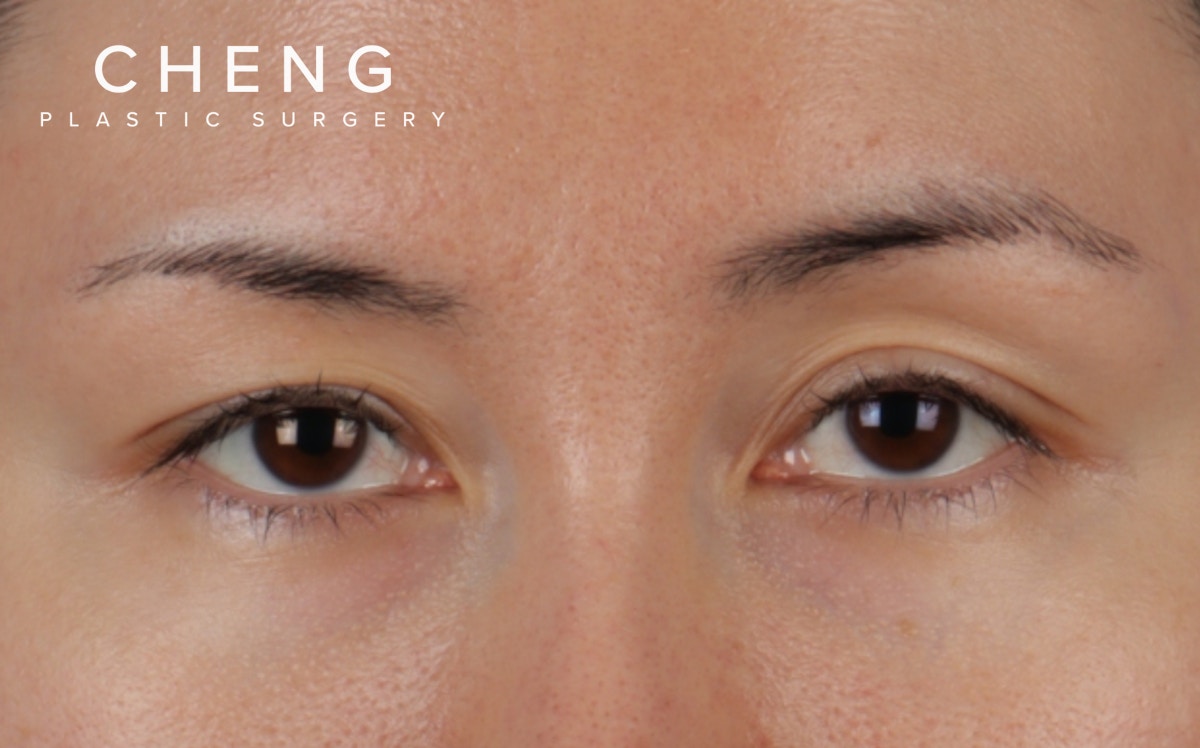 Blepharoplasty Before & After Gallery - Patient 751991 - Image 1