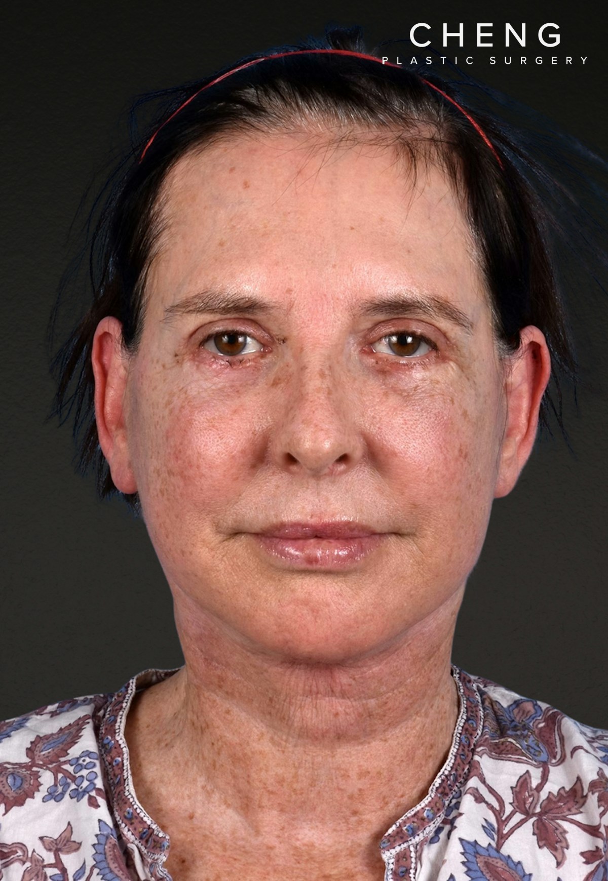 Brow Lift Before & After Gallery - Patient 488051 - Image 2