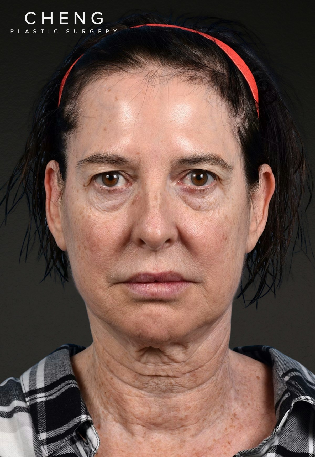 Brow Lift Before & After Gallery - Patient 488051 - Image 1