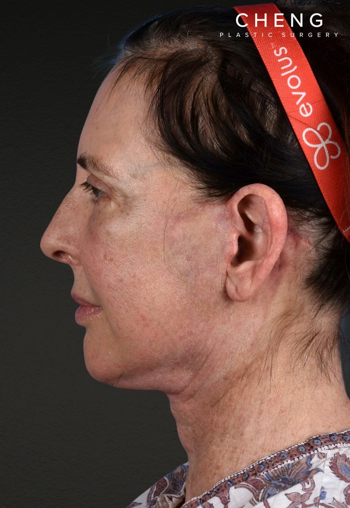Brow Lift Before & After Gallery - Patient 488051 - Image 8