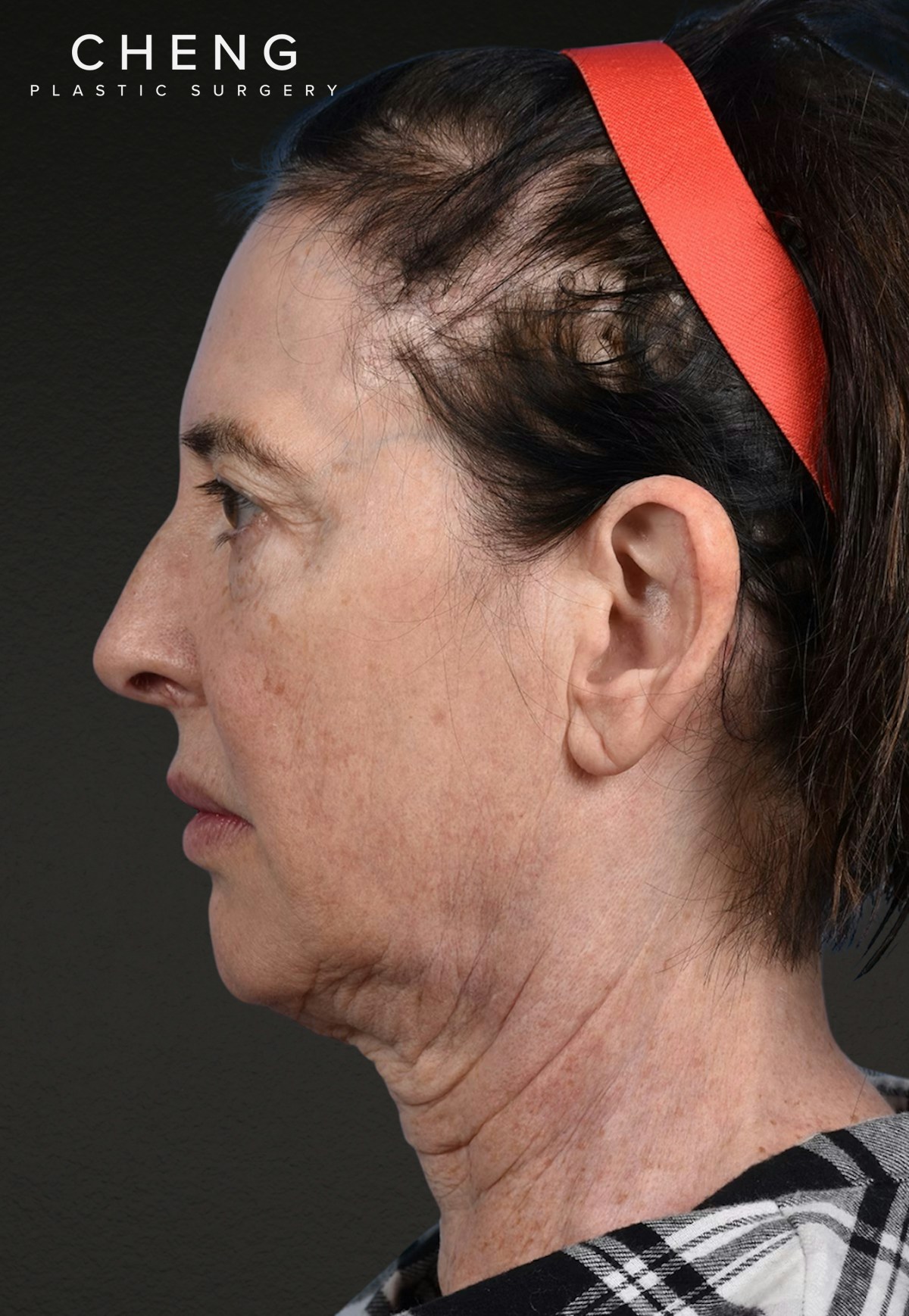 Brow Lift Before & After Gallery - Patient 488051 - Image 7