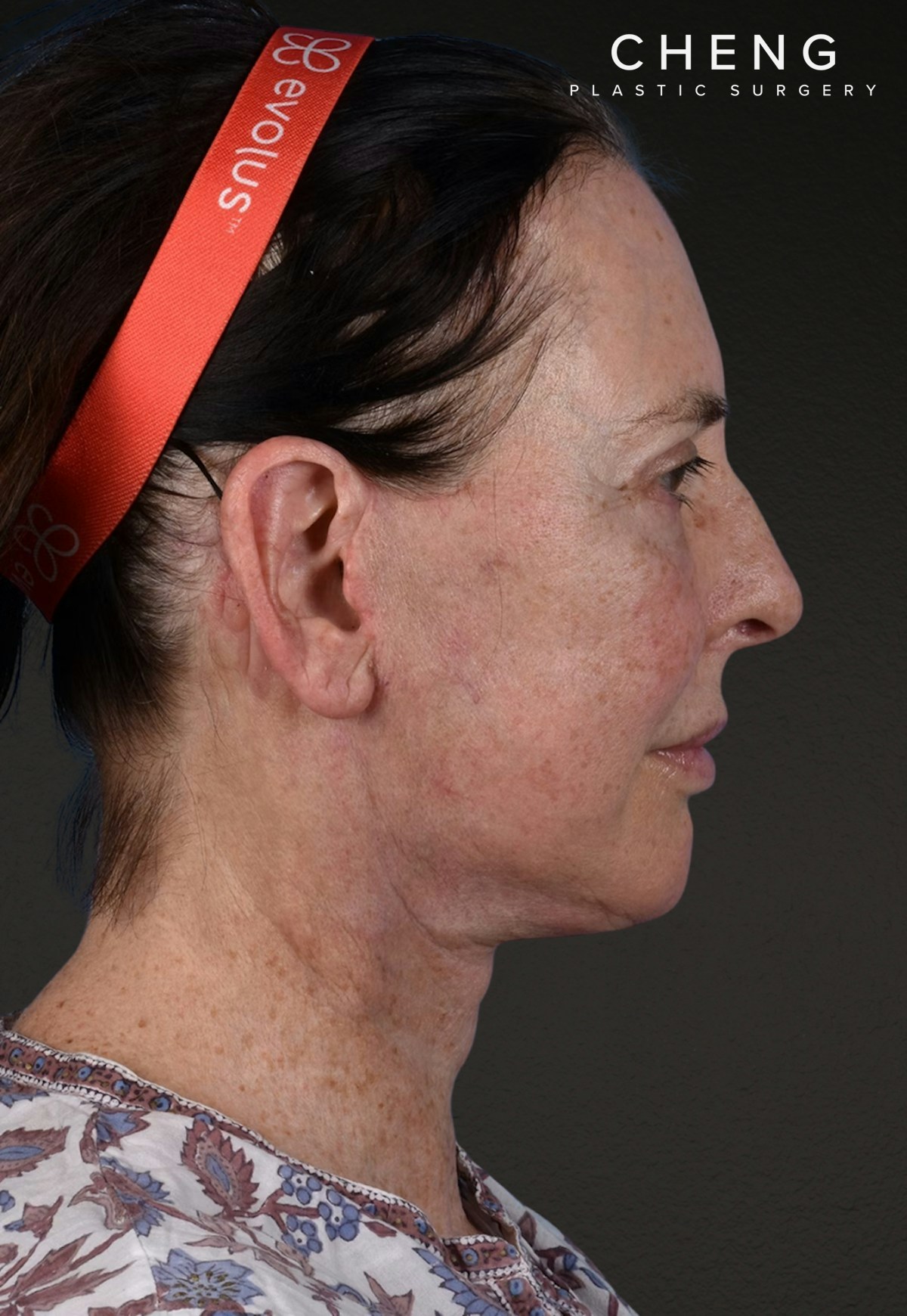 Brow Lift Before & After Gallery - Patient 488051 - Image 6