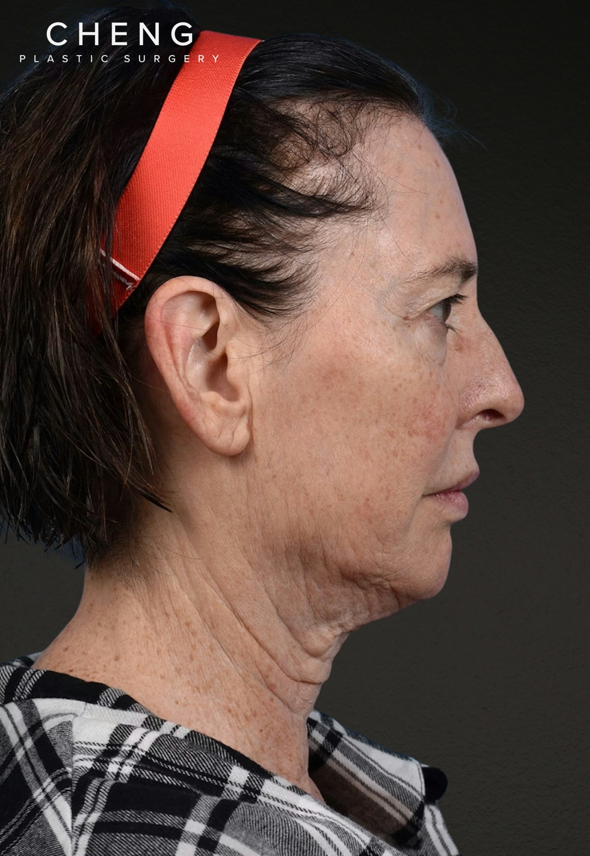 Brow Lift Before & After Gallery - Patient 488051 - Image 5