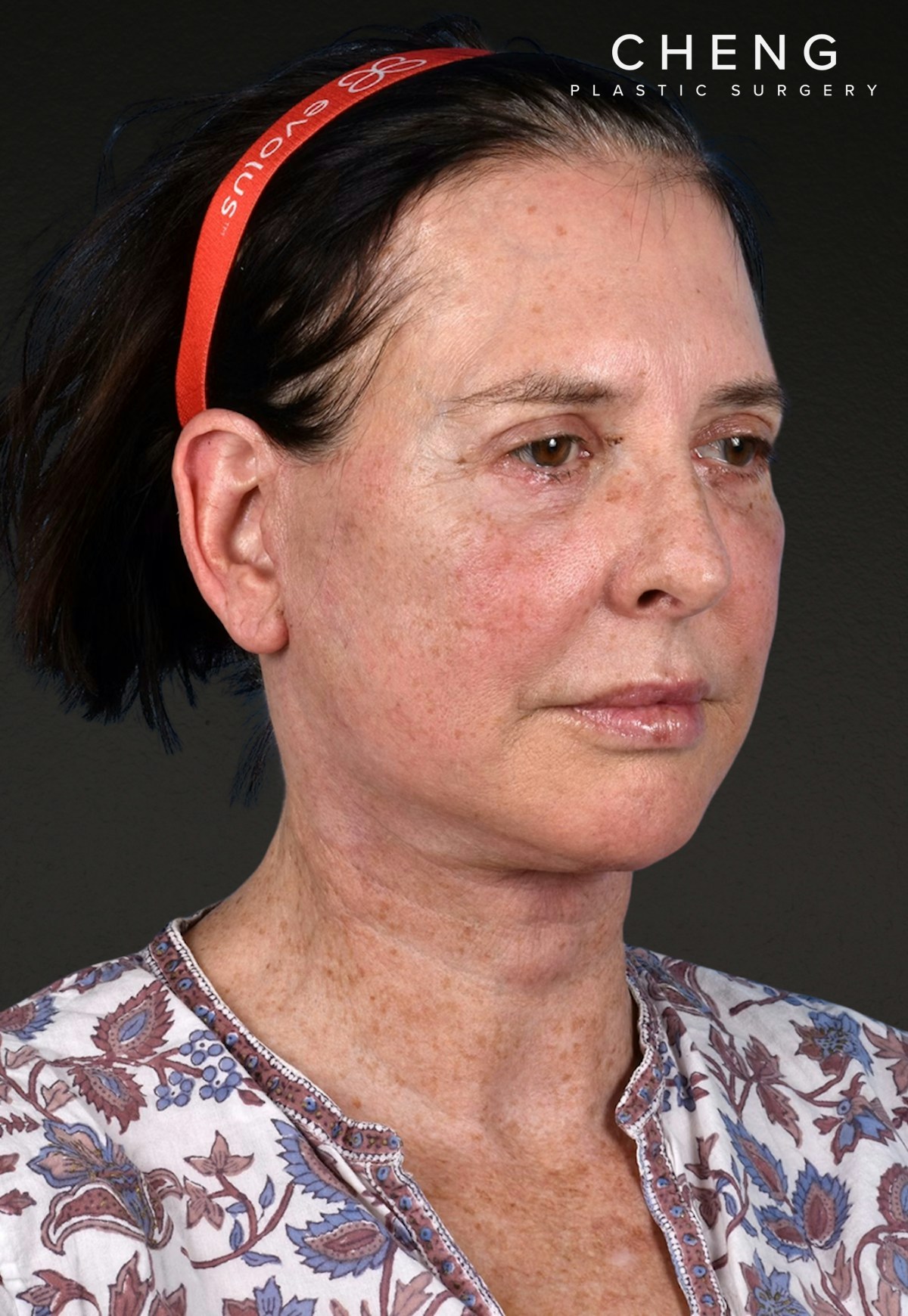Brow Lift Before & After Gallery - Patient 488051 - Image 4
