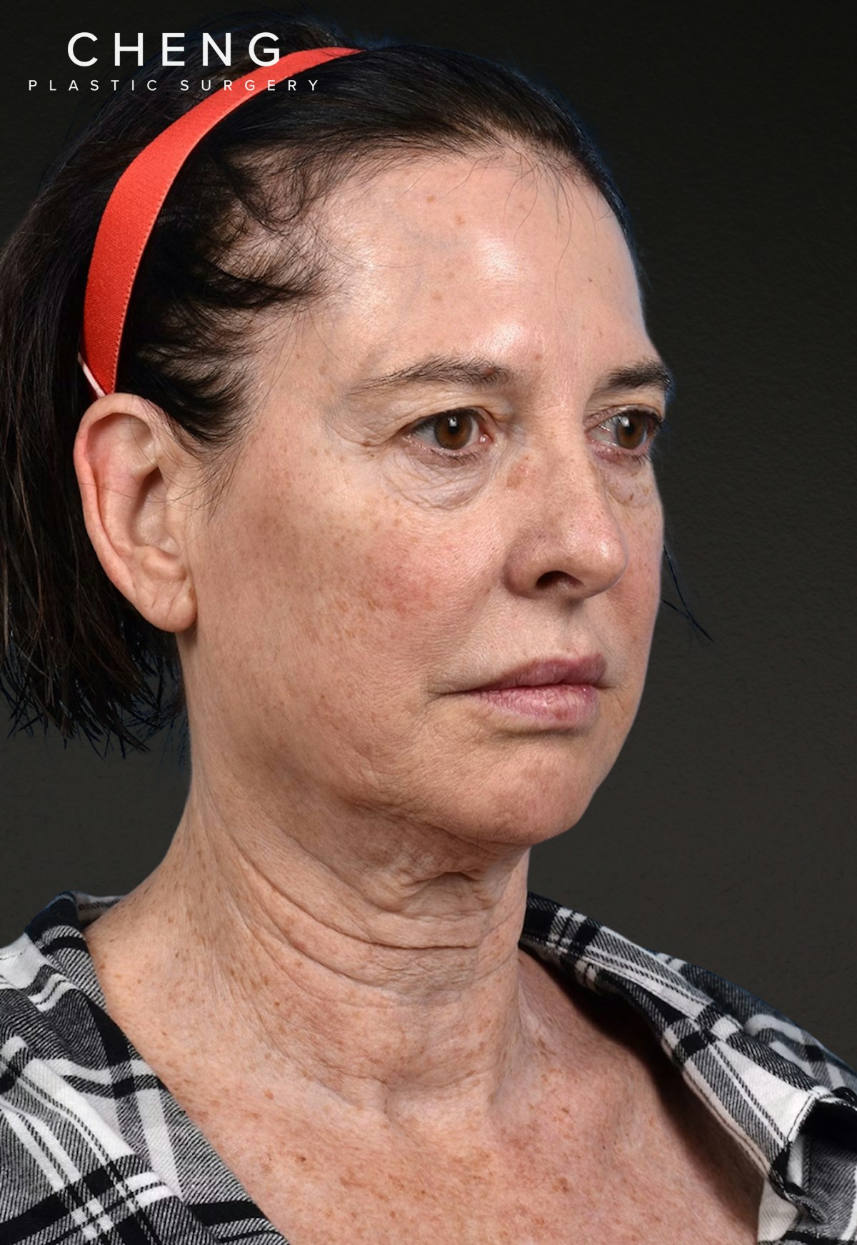 Brow Lift Before & After Gallery - Patient 488051 - Image 3
