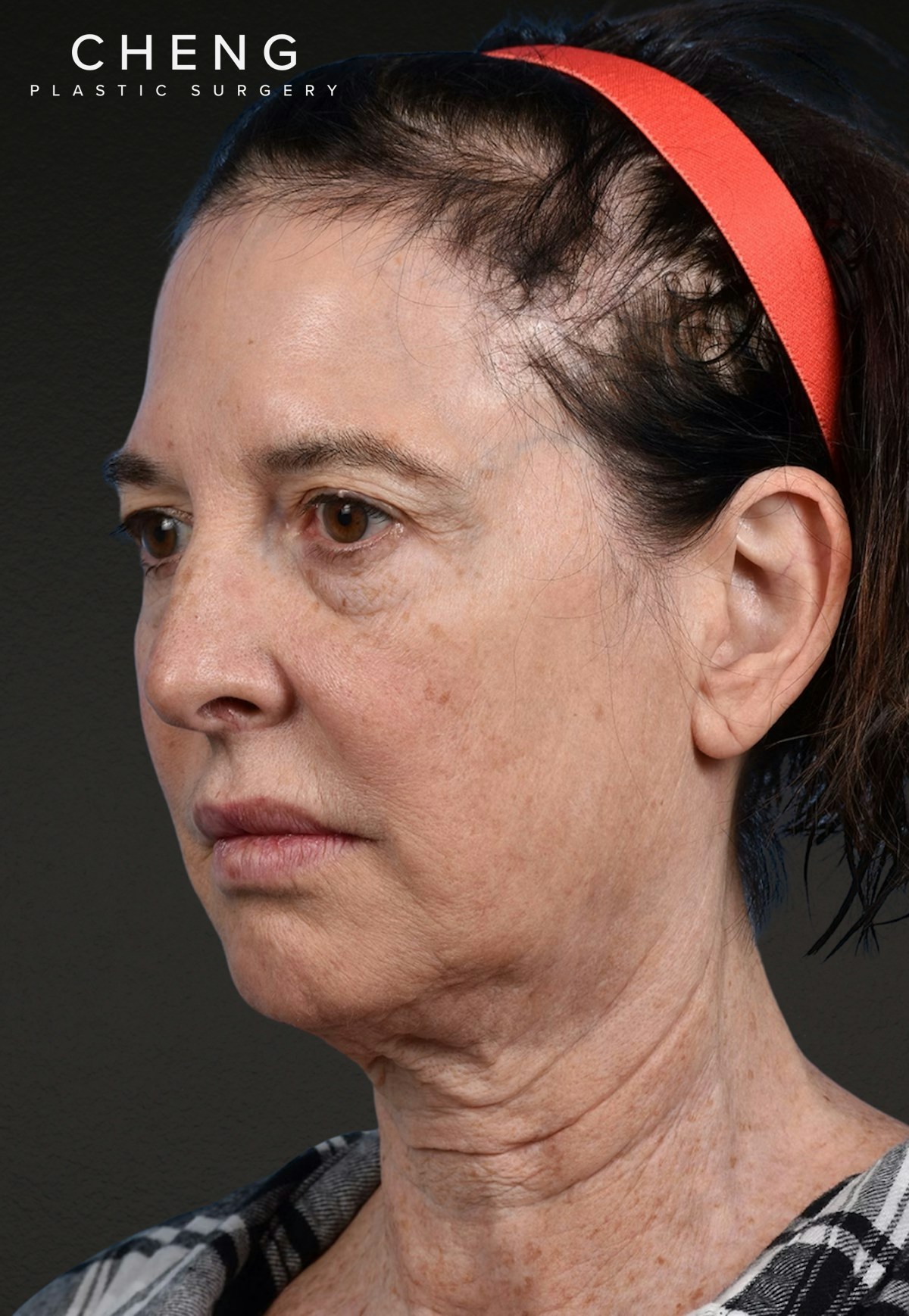 Brow Lift Before & After Gallery - Patient 488051 - Image 9