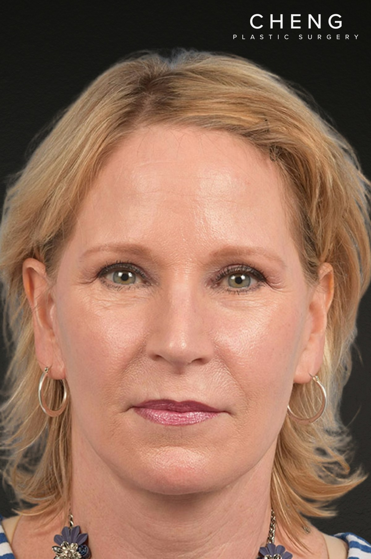 Brow Lift Before & After Gallery - Patient 415432 - Image 2