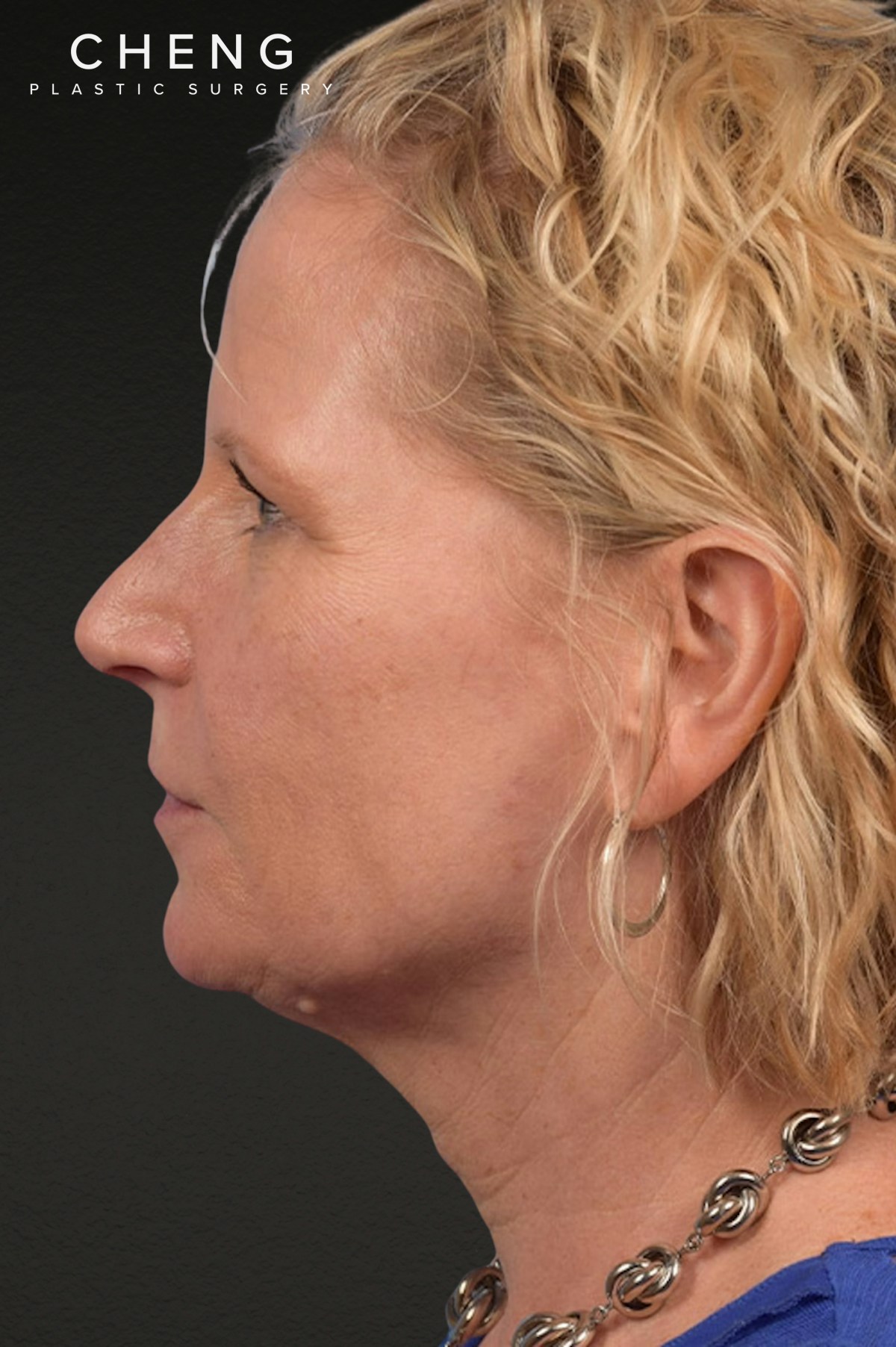 Brow Lift Before & After Gallery - Patient 415432 - Image 9