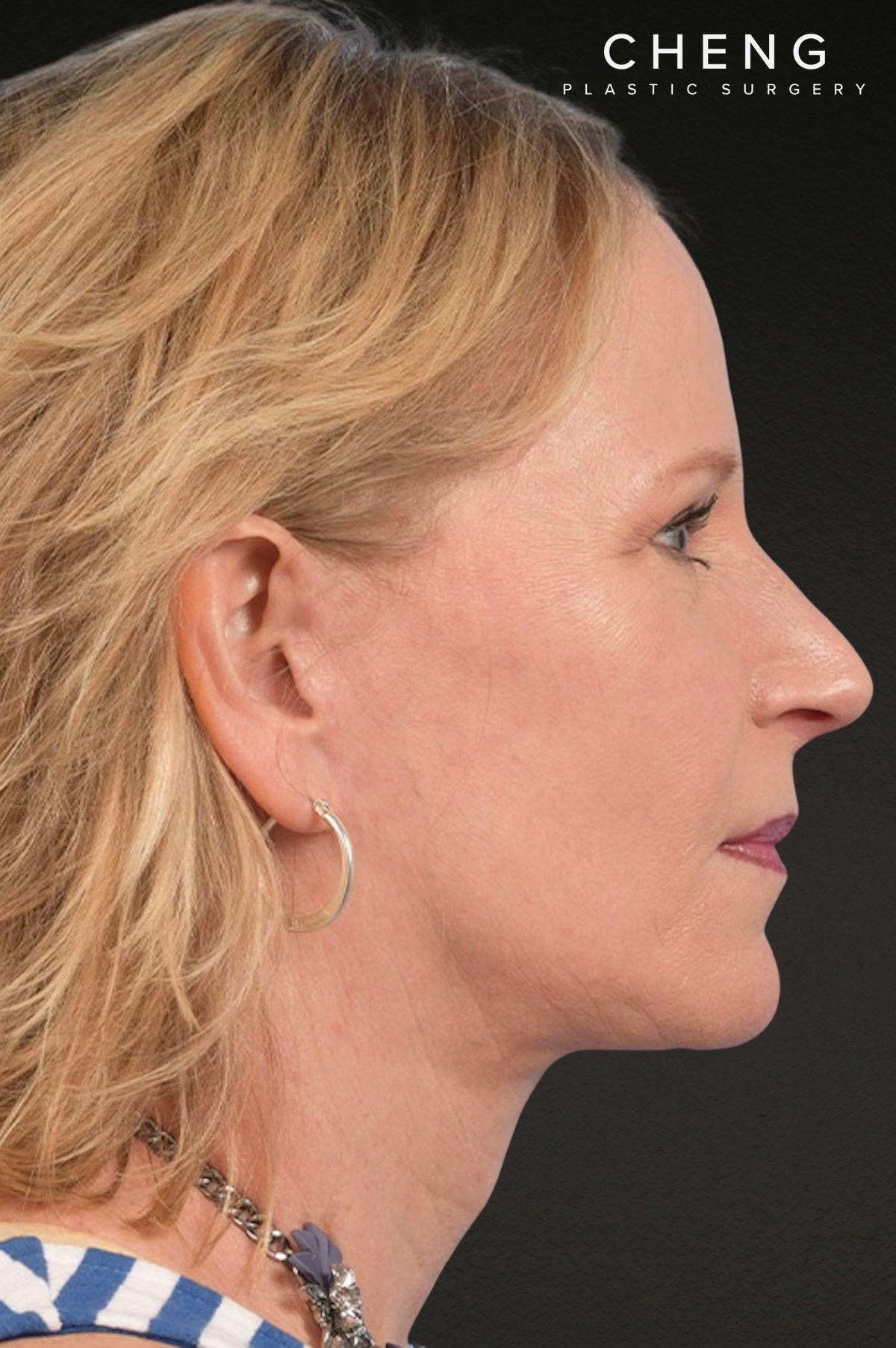 Brow Lift Before & After Gallery - Patient 415432 - Image 6