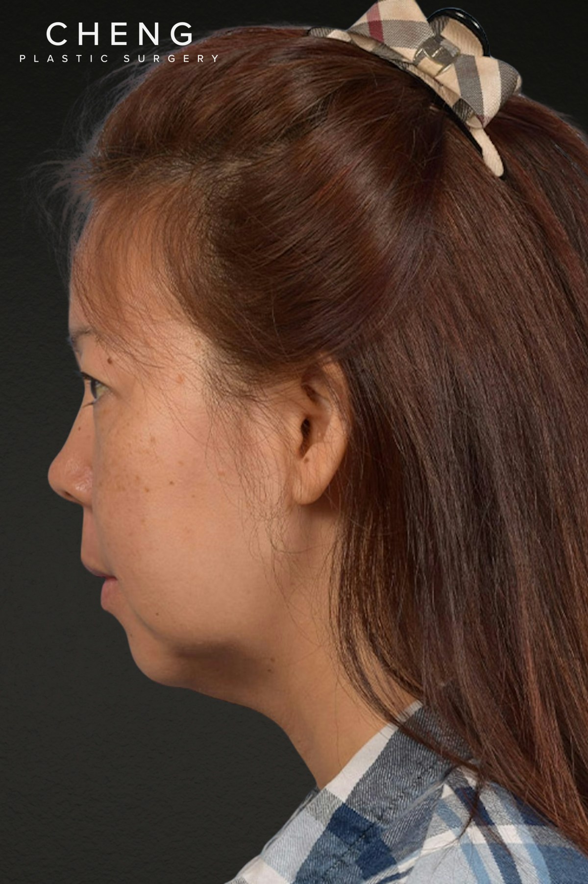 Chin Augmentation Before & After Gallery - Patient 163562 - Image 3