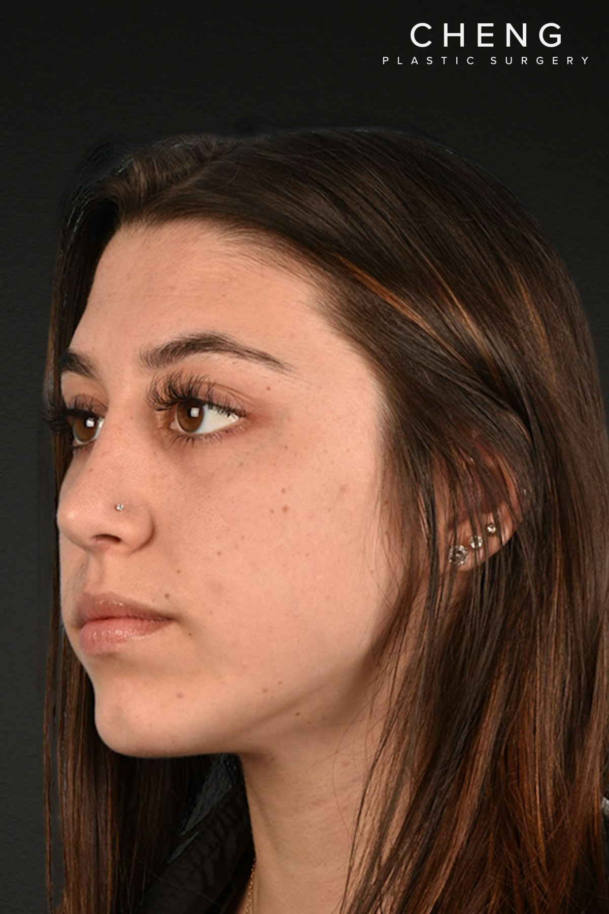 Chin Augmentation Before & After Gallery - Patient 290451 - Image 2