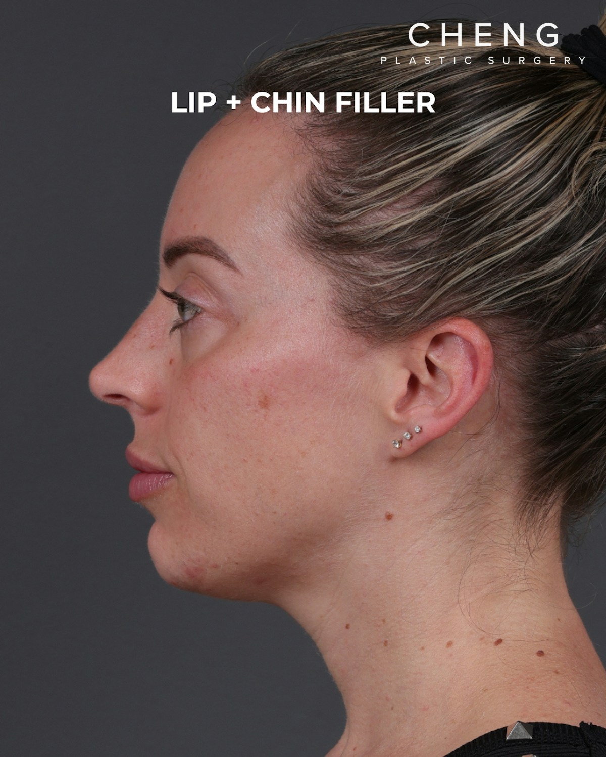 Dermal Fillers Before & After Gallery - Patient 916688 - Image 10