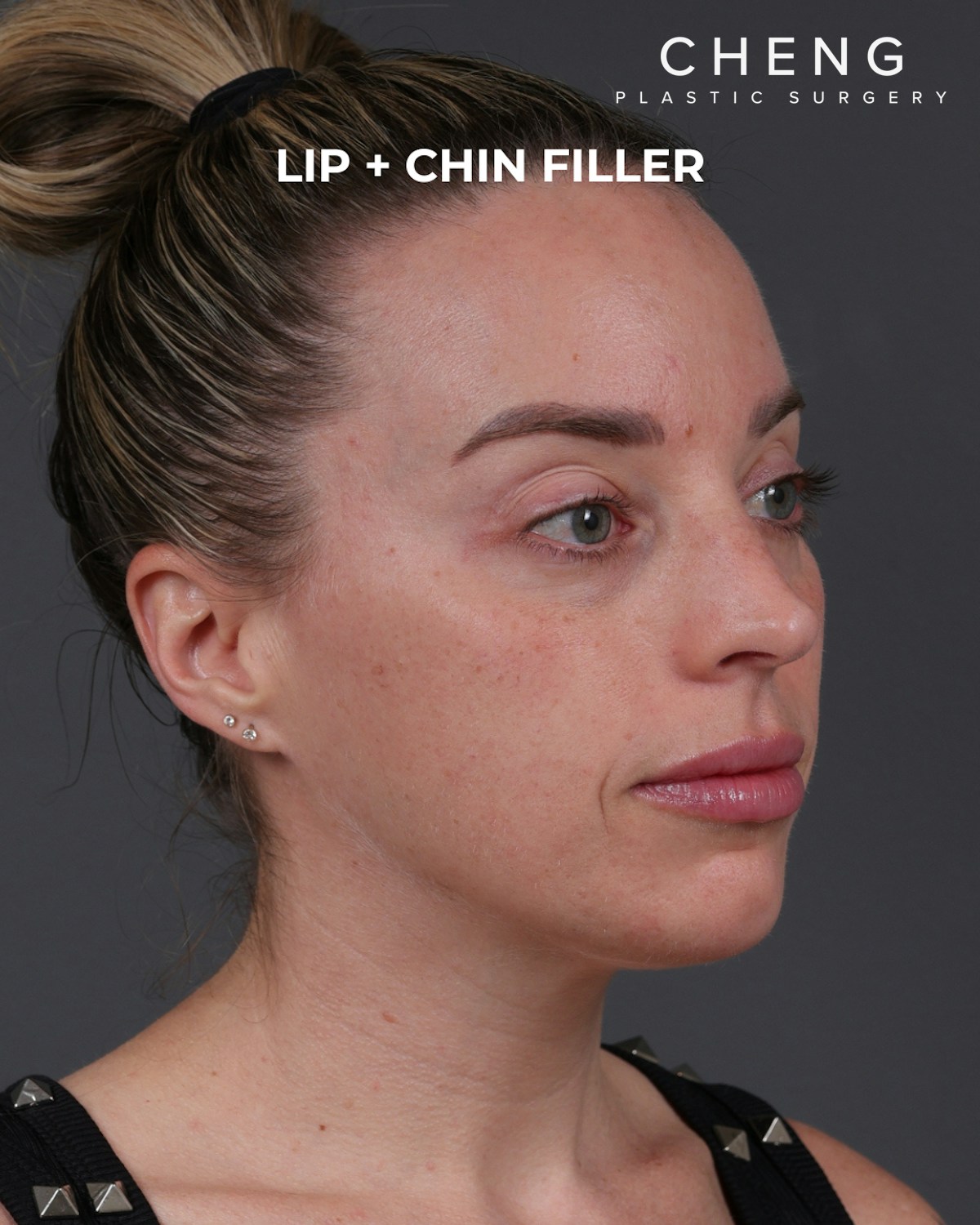 Dermal Fillers Before & After Gallery - Patient 916688 - Image 4