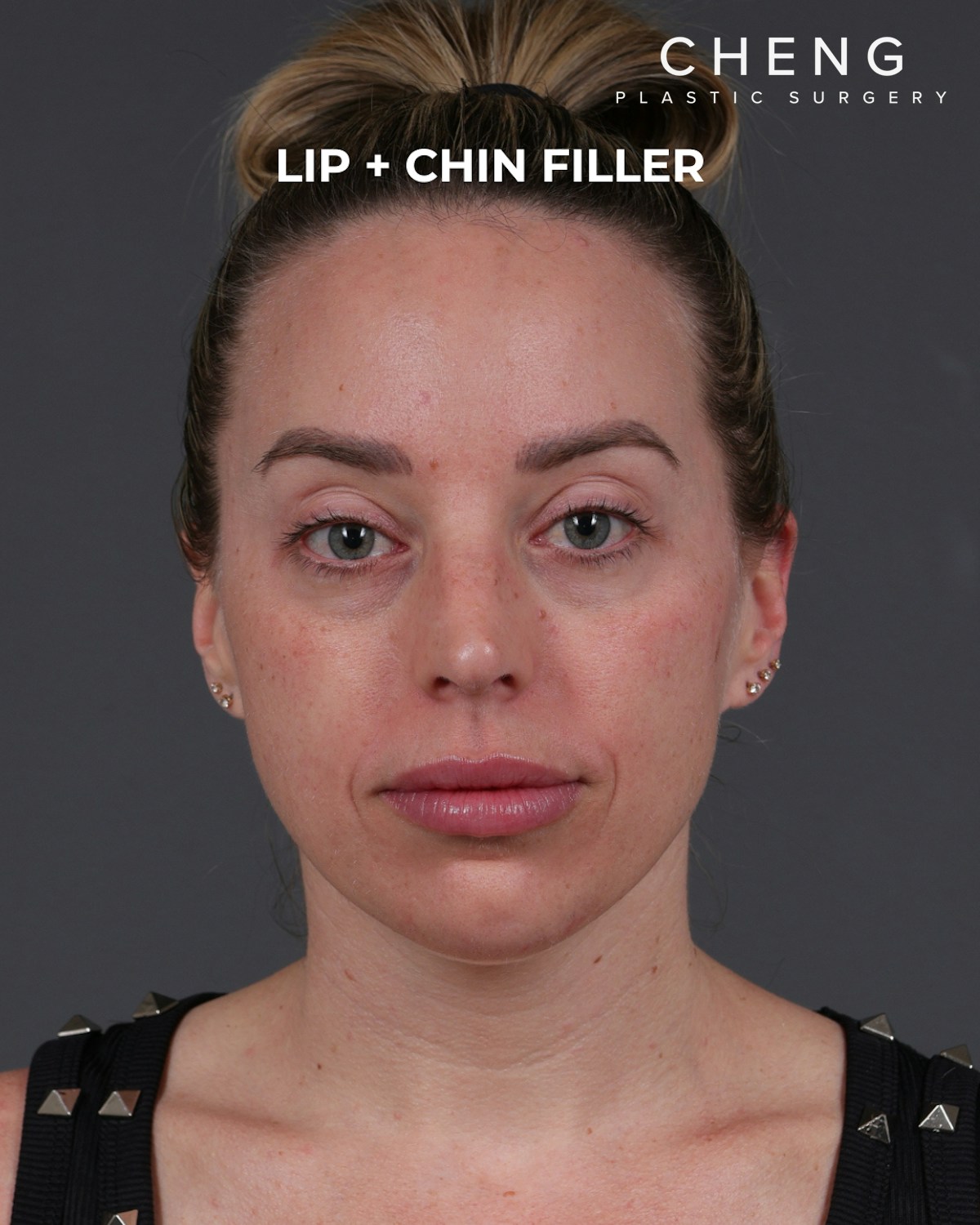 Dermal Fillers Before & After Gallery - Patient 916688 - Image 2