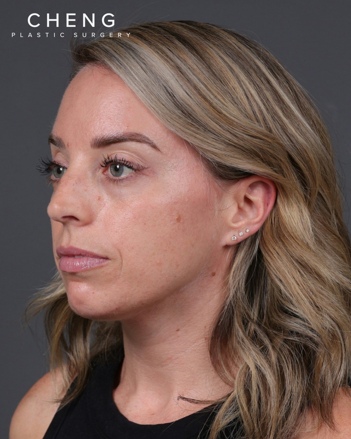 Dermal Fillers Before & After Gallery - Patient 916688 - Image 7