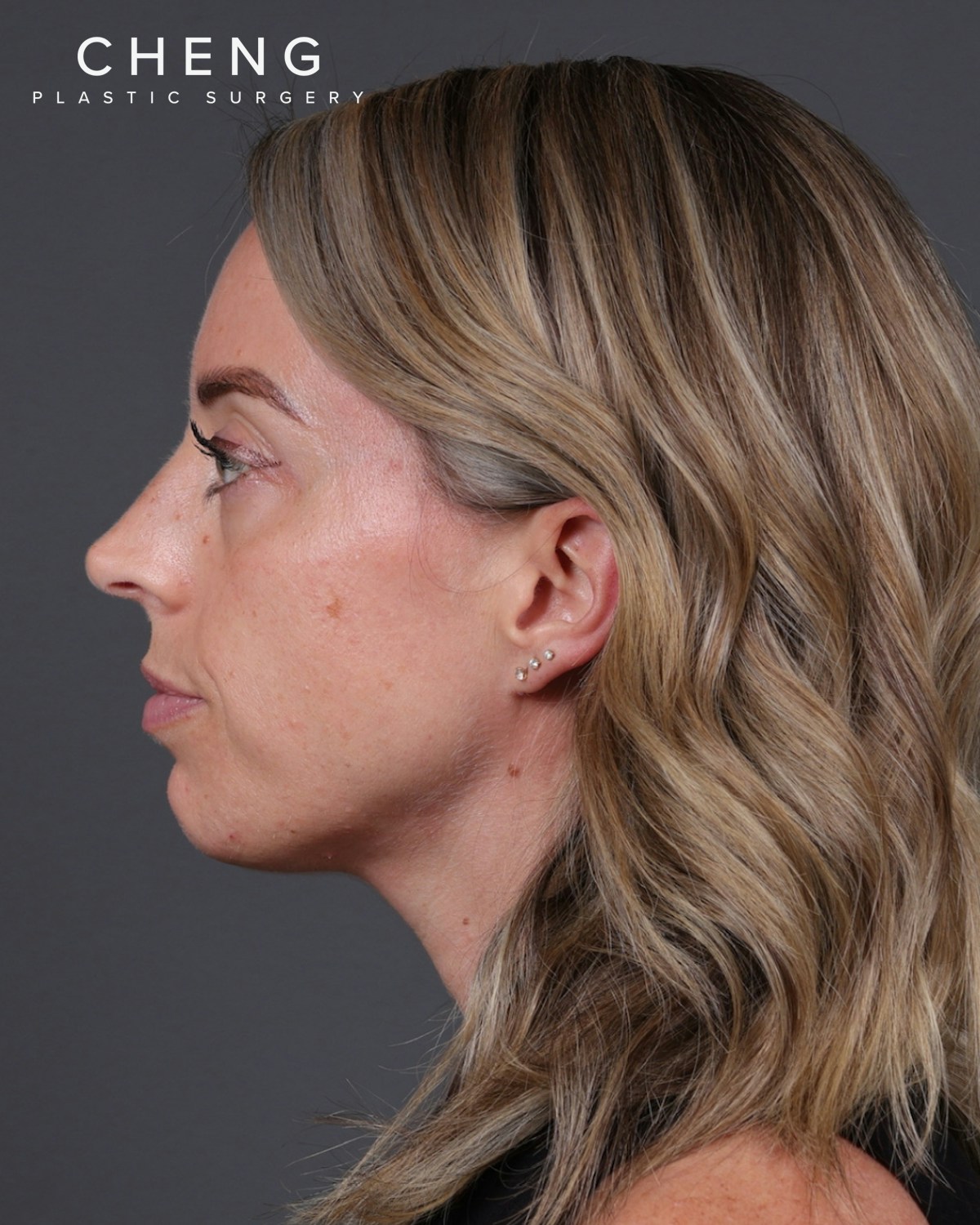 Dermal Fillers Before & After Gallery - Patient 916688 - Image 9
