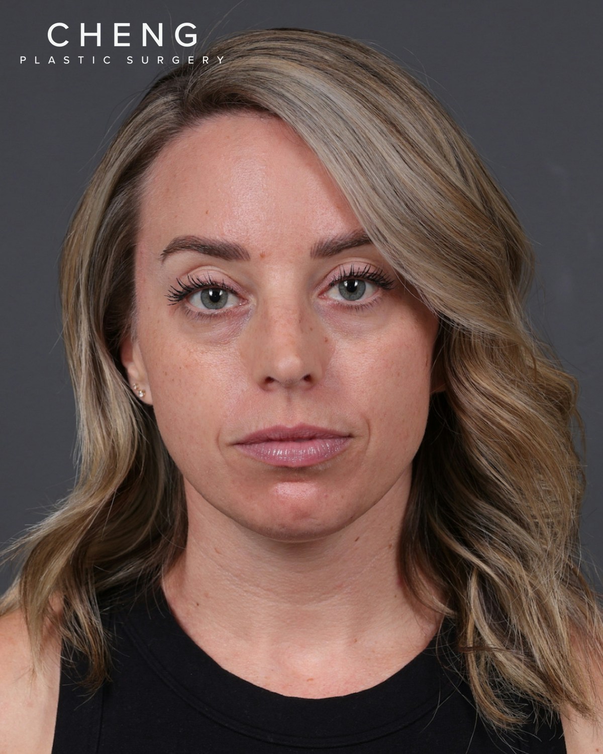 Dermal Fillers Before & After Gallery - Patient 916688 - Image 1