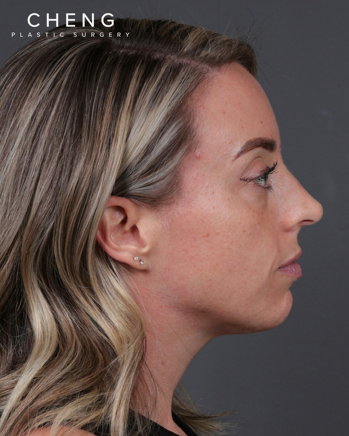 Dermal Fillers Before & After Gallery - Patient 916688 - Image 5